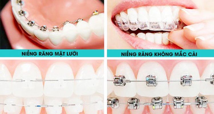 Các loại niềng răng
