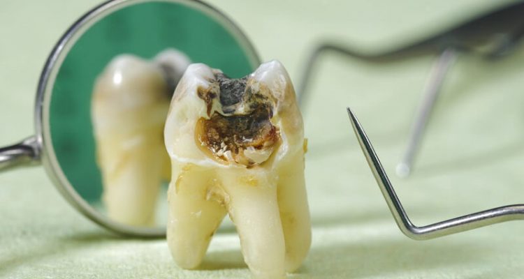 Tác hại của sâu răng