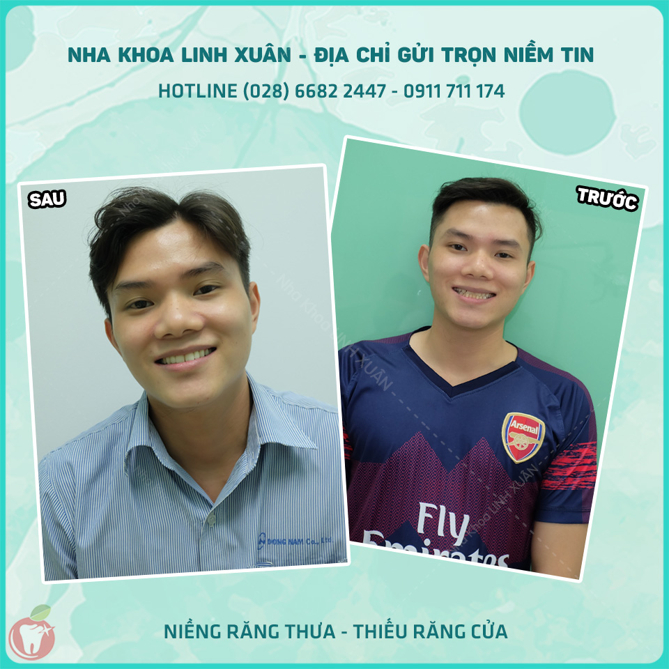 KẾT QUẢ TRƯỚC SAU NIỀNG RĂNG TẠI NHA KHOA LINH XUÂN