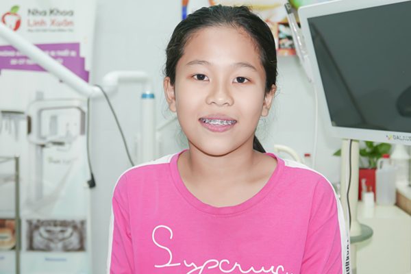 Niềng răng mắc cài kim loại
