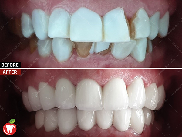 Khắc phục răng phủ sứ Nano