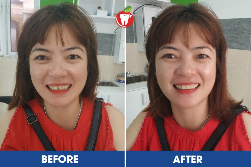 Khách hàng trám răng tại Nha Khoa LINH XUÂN