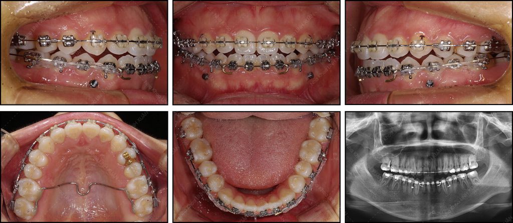 Niềng răng với trường hợp mất răng số 6