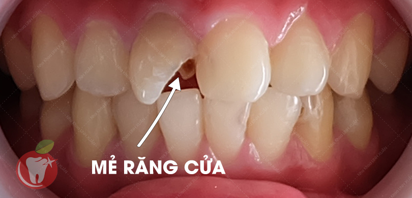 Răng cửa mẻ