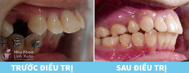 Kết quả niềng răng
