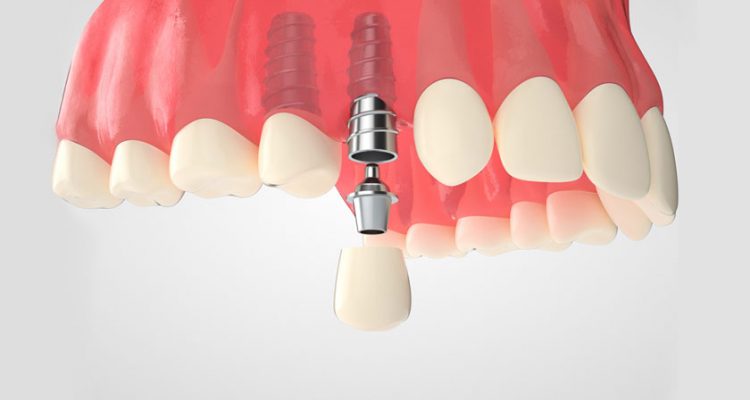 Cấy ghép Implant