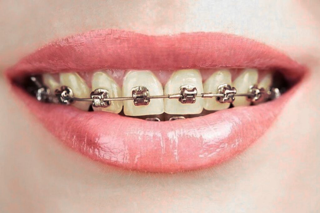Răng ố vàng sau niềng răng