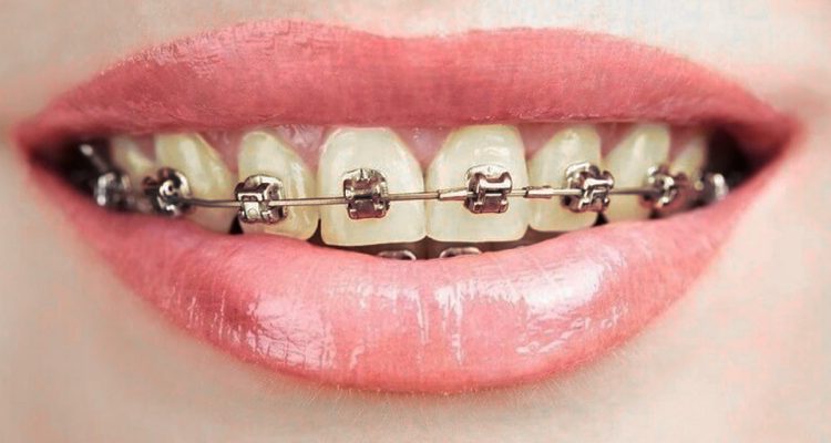 Răng ố vàng sau niềng răng