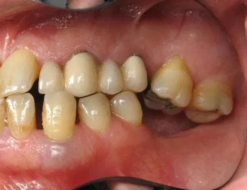 Ảnh hưởng khi mất răng số 7