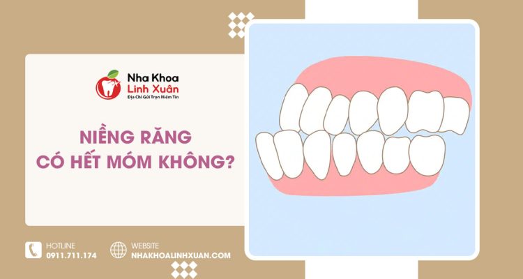 Niềng răng có hết móm không