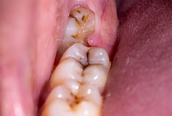 Viêm Lợi Trùm Răng Khôn
