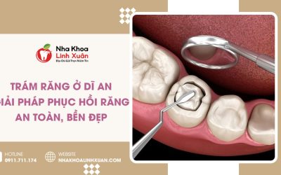 Trám răng ở Dĩ An
