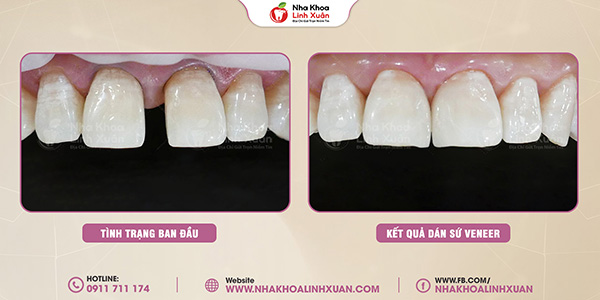 Dán sứ Veneer răng thưa