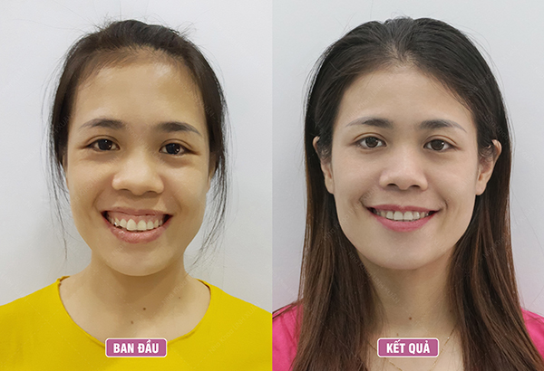 Niềng răng có chữa được cười hở lợi không?