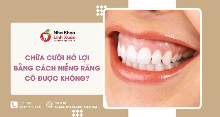 Niềng răng có chữa được cười hở lợi không?