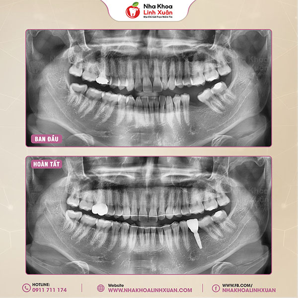 Niềng răng kết hợp Implant