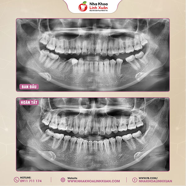 Mất răng số 6 có niềng được không