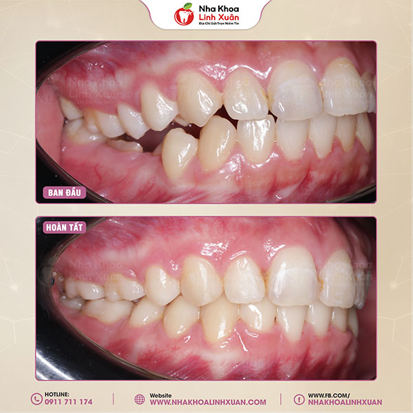 Mất răng số 6 có niềng được không