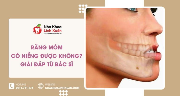 Răng móm có niềng được không? Giải thích từ bác sĩ
