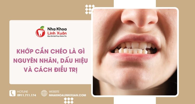 Khớp cắn chéo là gì? Dấu hiệu & cách điều trị hiệu quả