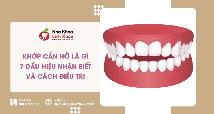 Khớp Cắn Hở Là Gì? 5 Dấu Hiệu Nhận Biết & Cách Điều Trị