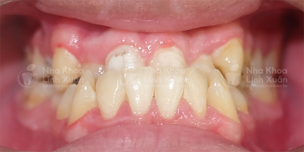 Khớp cắn ngược