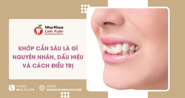 Khớp cắn sâu là gì? Nguyên nhân, dấu hiệu và 3 cách điều trị