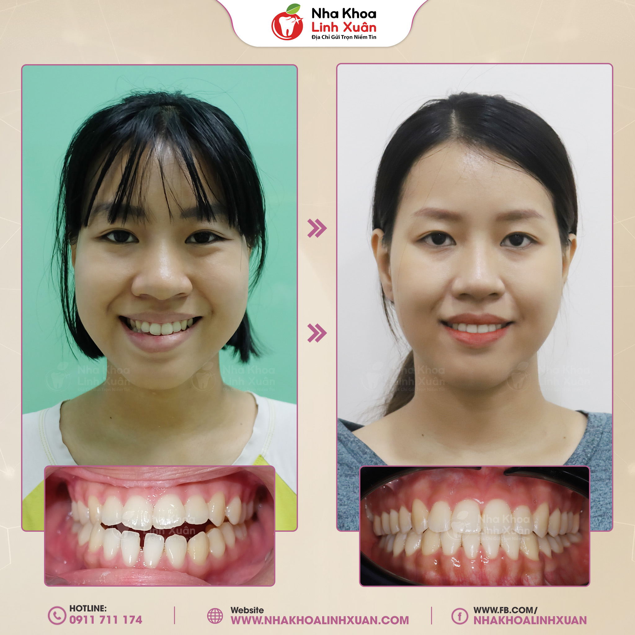 Niềng răng khớp cắn hở