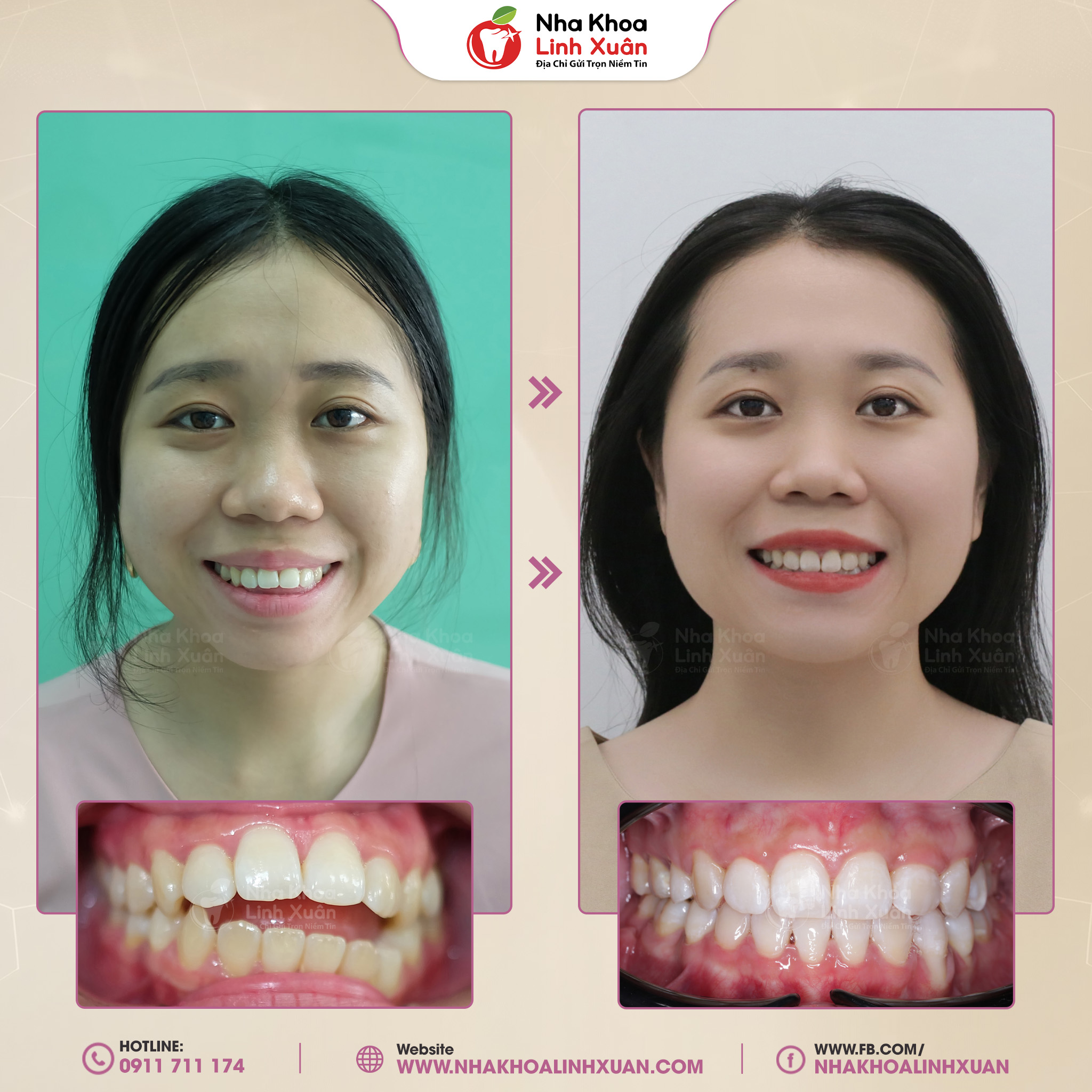 Niềng răng khớp cắn hở