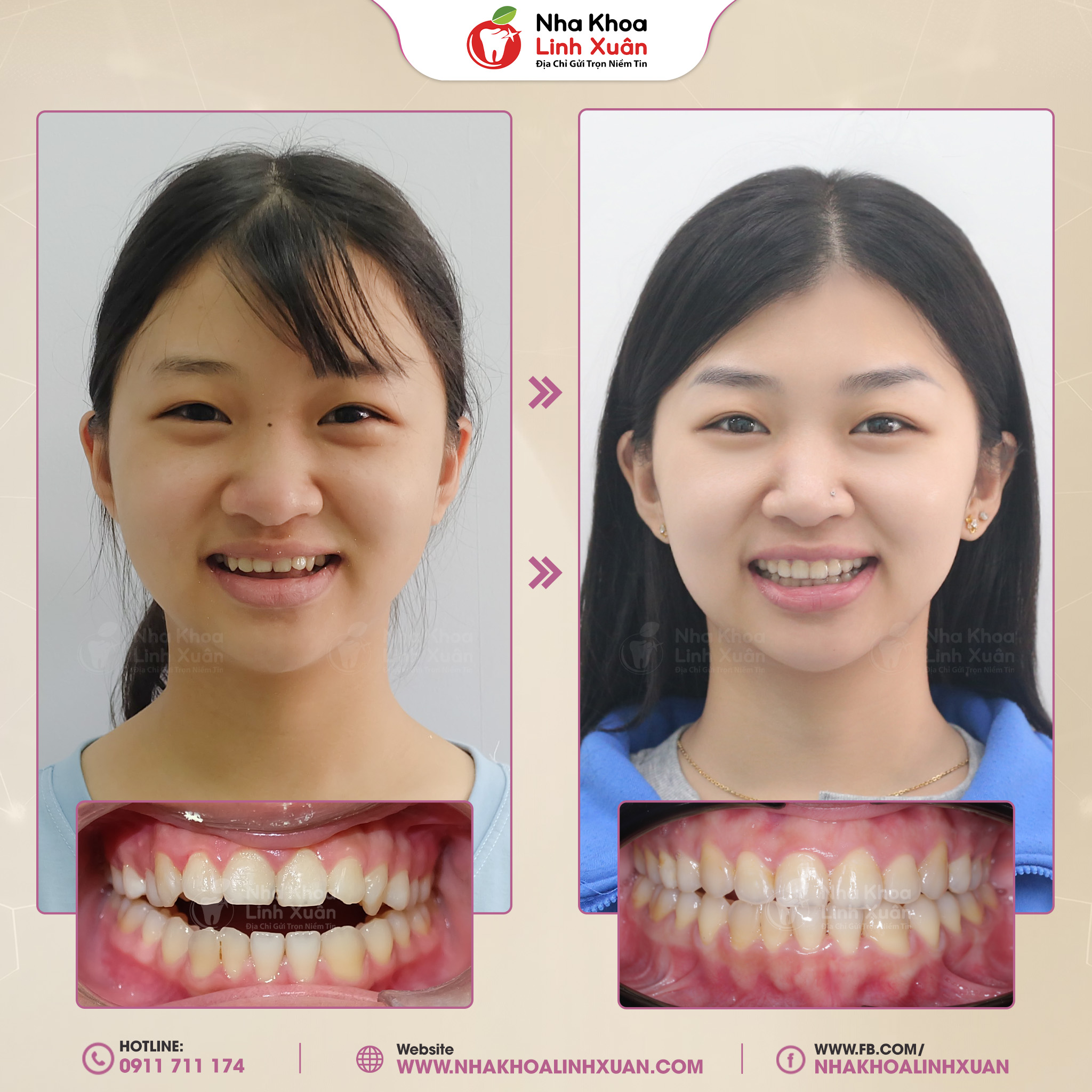 Niềng răng khớp cắn hở