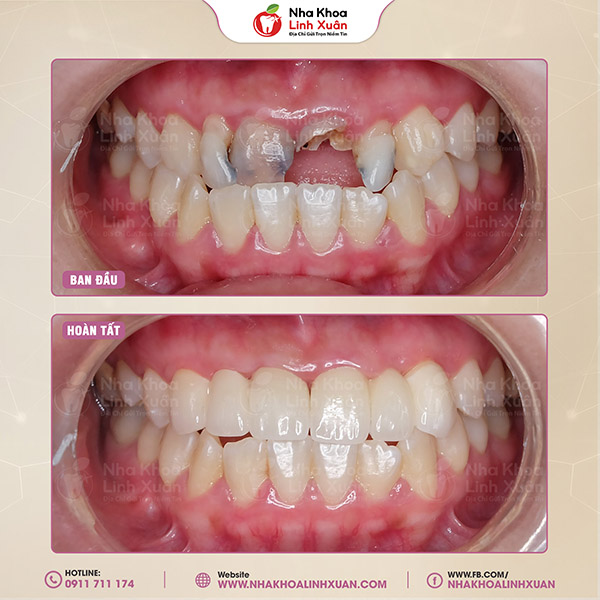 Răng móm có bọc sứ được không