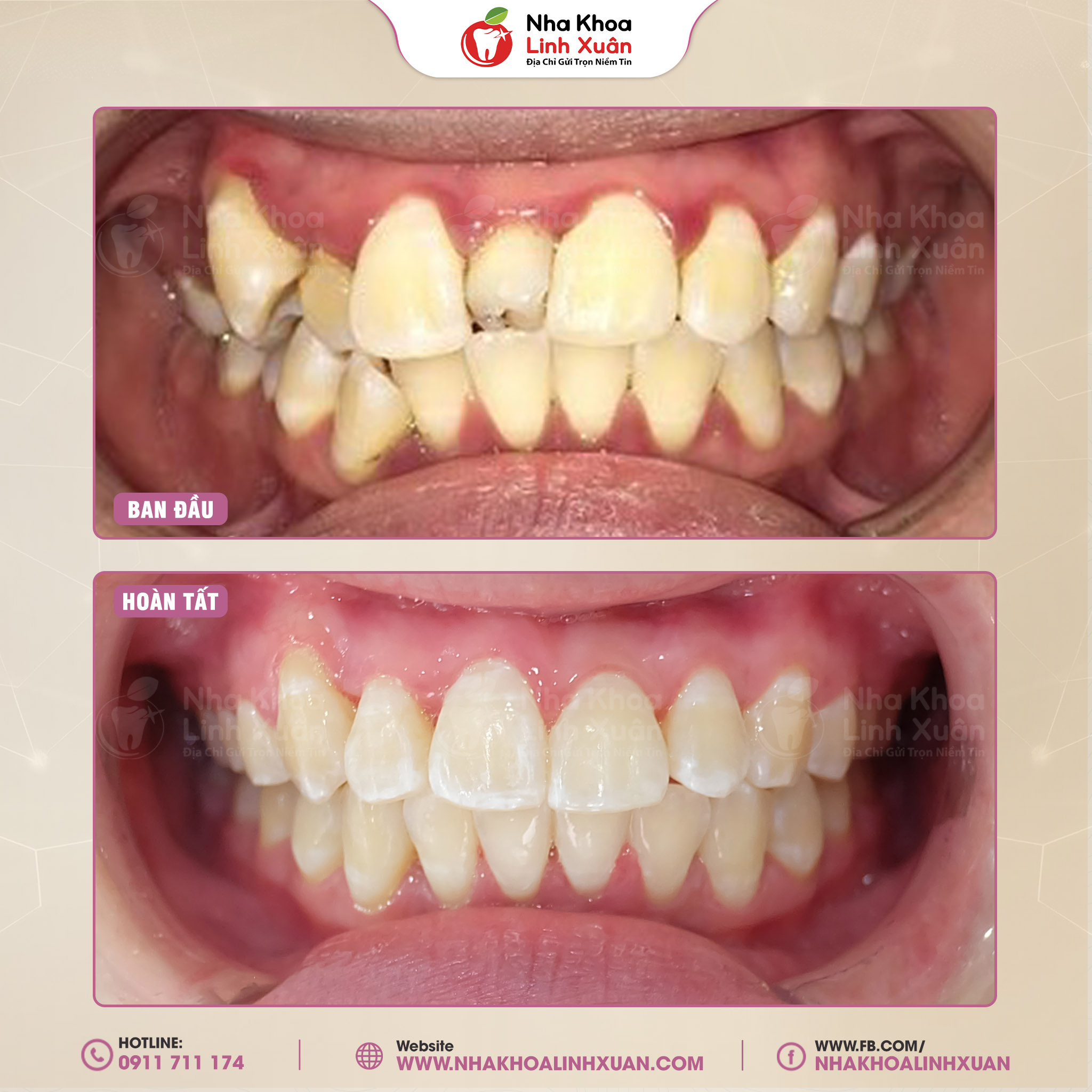 Răng dư kẽ giữa