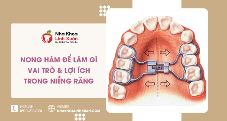 Nong hàm để làm gì? Vai trò và lợi ích trong niềng răng