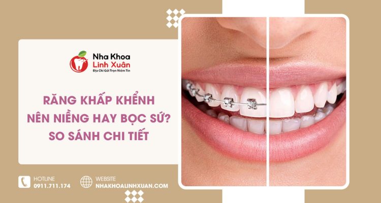 Răng khấp khểnh nên niềng hay bọc sứ? So sánh chi tiết
