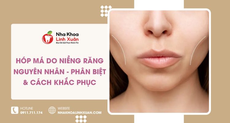 Hóp má do niềng răng: Nguyên nhân & cách khắc phục