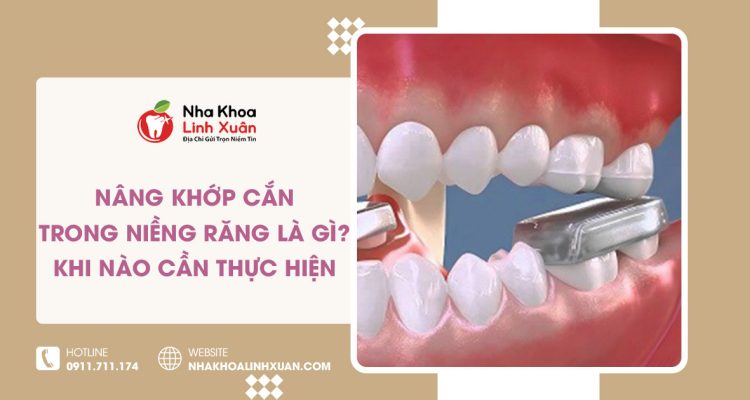 Nâng khớp cắn trong niềng răng là gì? Khi nào cần thực hiện