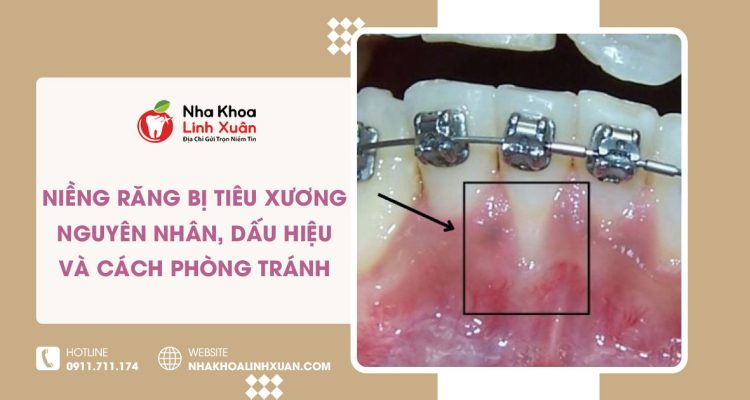 Niềng răng bị tiêu xương: Nguyên nhân & cách phòng tránh