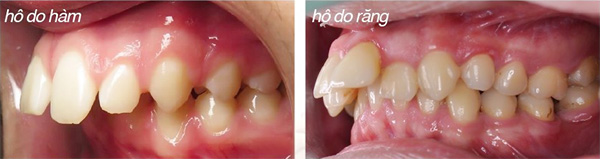 Phân biệt hô do răng và hô do xương hàm