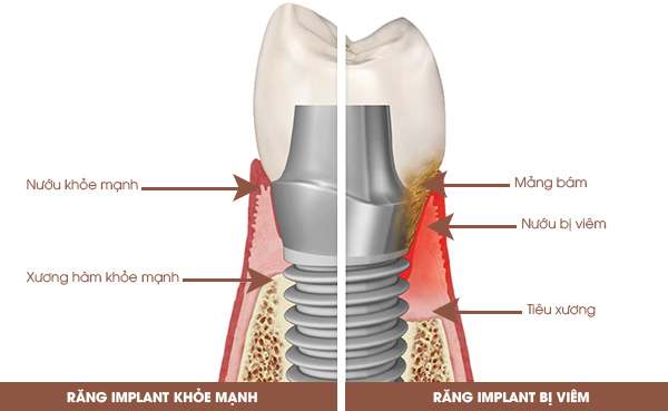 Viêm quanh Implant