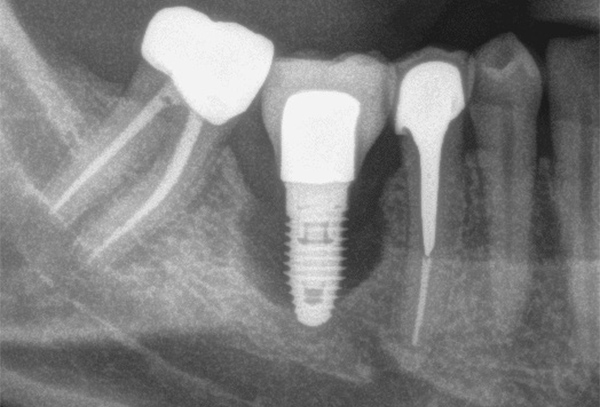 Viêm quanh Implant