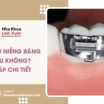 Gắn khâu niềng răng có đau không? Giải đáp chi tiết