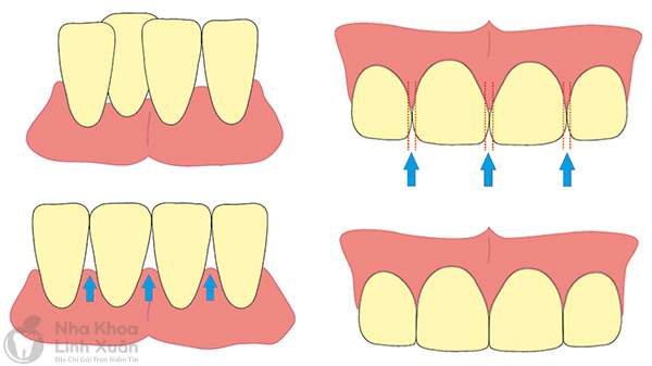 Mài kẽ răng tạo không gian dịch chuyển trong niềng