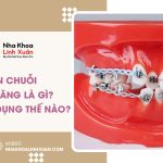 Thun chuỗi niềng răng là gì? Có công dụng thế nào?