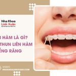 Thun liên hàm là gì? Cách đeo thun liên hàm khi niềng răng