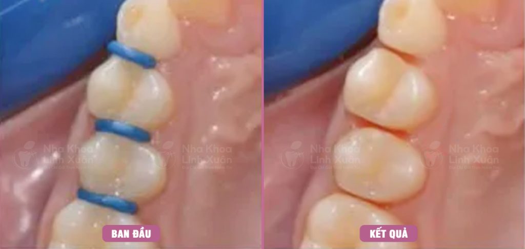 Đặt thun tách kẽ trong niềng răng
