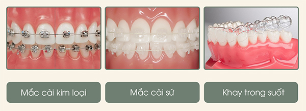 Các loại mắc cài niềng răng phổ biến hiện nay.