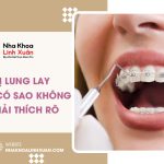 Răng lung lay khi niềng có sao không?