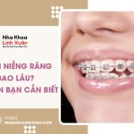 Thời gian niềng răng mất bao lâu? 5 giai đoạn cần biết