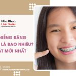 Chi phí niềng răng trẻ em là bao nhiêu? Cập nhật mới nhất