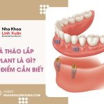 Hàm giả tháo lắp trên Implant là gì? Ưu nhược điểm cần biết